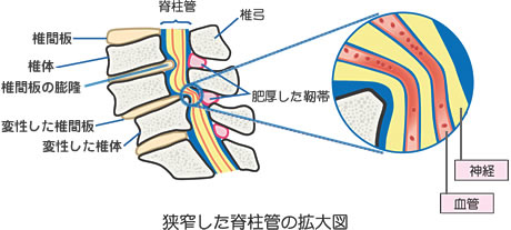 狭窄した脊柱管の拡大図